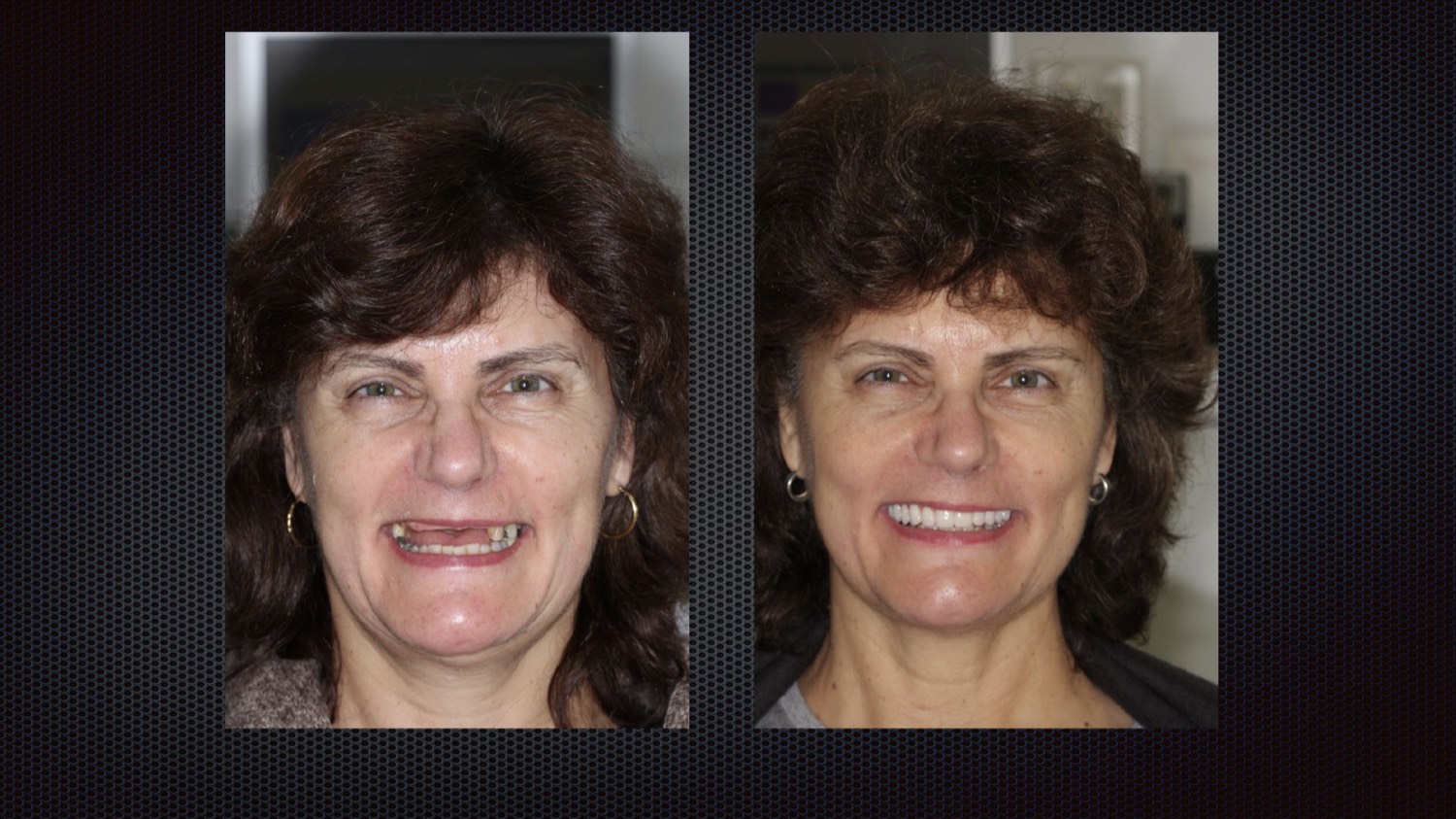 Before and after full-arch implant results
