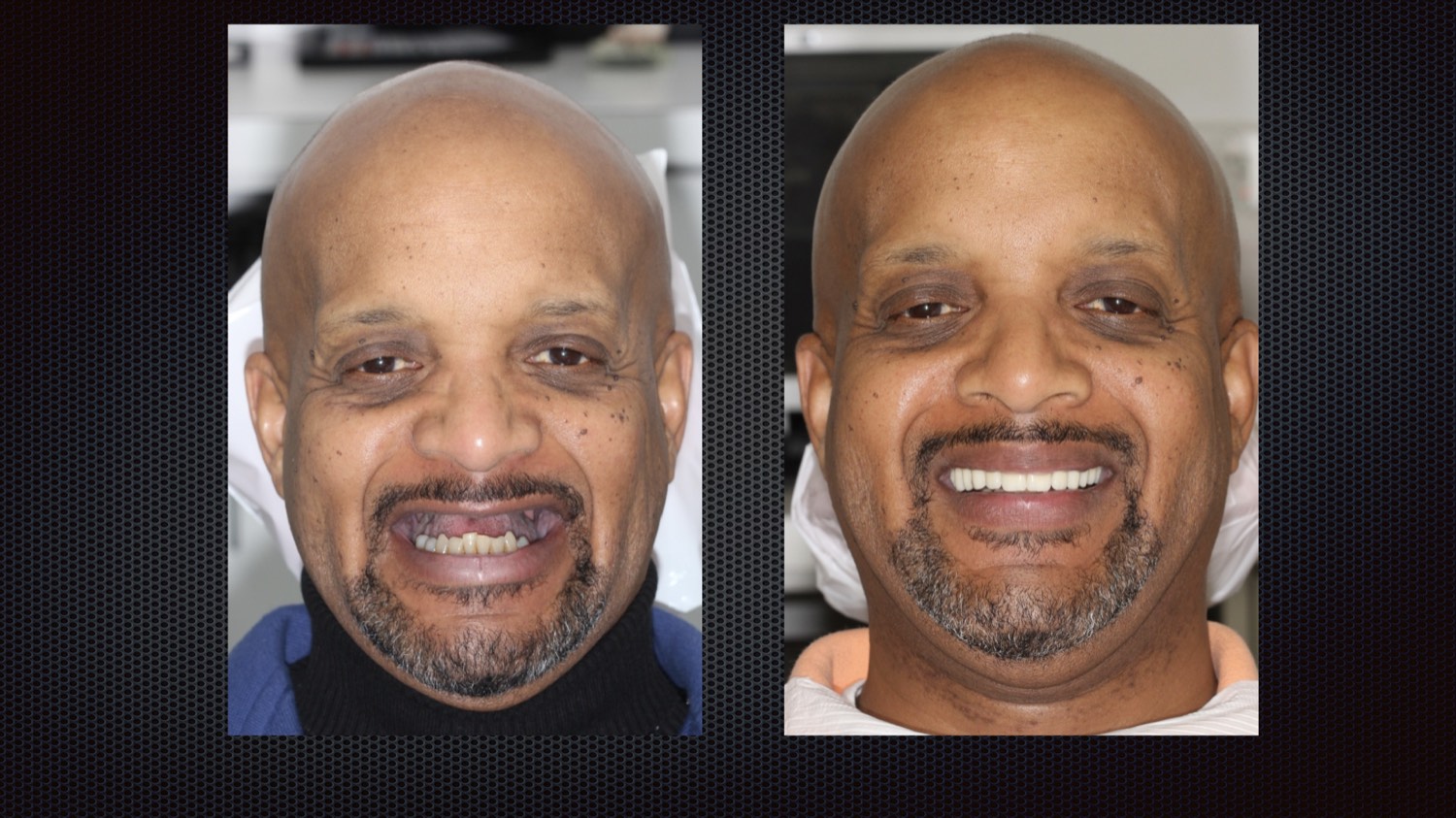Before and after full-arch implant results