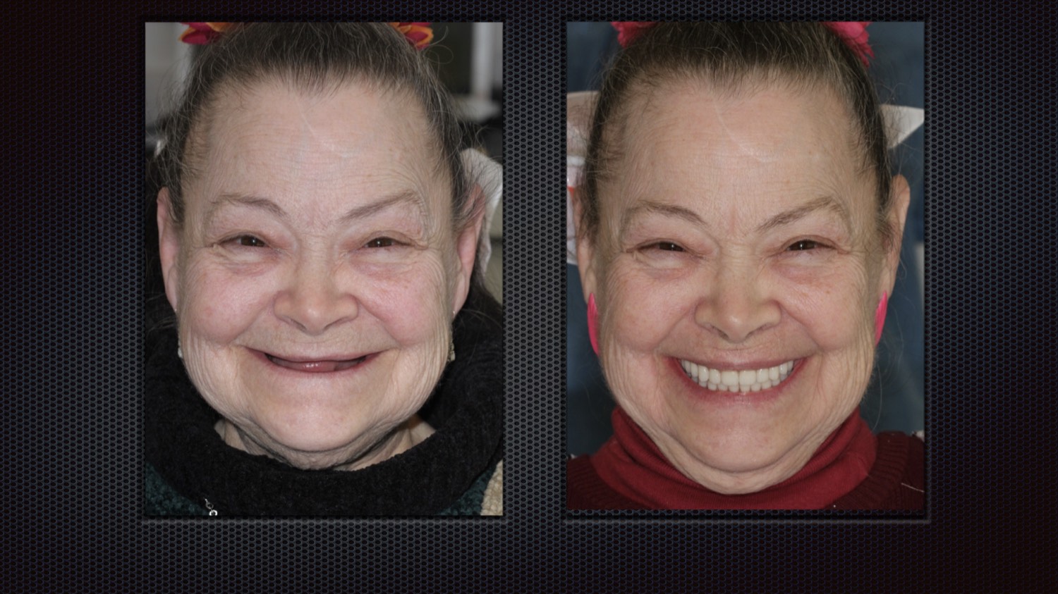 Before and after full-arch implant results